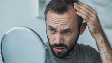 Mann im mittleren Alter mit Haarausfall sieht sich im Spiegel an: Bei etwa 80 Prozent der Männer ist ein Haarausfall genetisch bedingt. Ursache dafür ist eine Überempfindlichkeit der Haarfollikel gegenüber dem männlichen Geschlechtshormon Dihydrotestosteron (DHT). Bei dieser Veranlagung schrumpfen und verkrümmen die Blutgefäße, die die Haarwurzeln mit Nährstoffen versorgen. Unter anderem wird ihre Wachstumsphase beeinträchtigt, so dass die Haare kürzer und weniger nachwachsen.