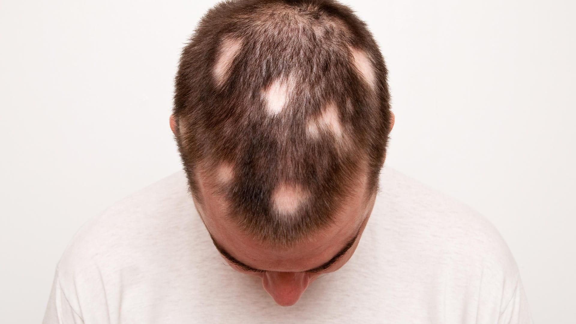 Kopf eines Mannes mit Alopecia areata