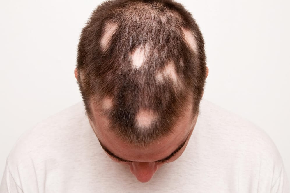 Kopf eines Mannes mit Alopecia areata