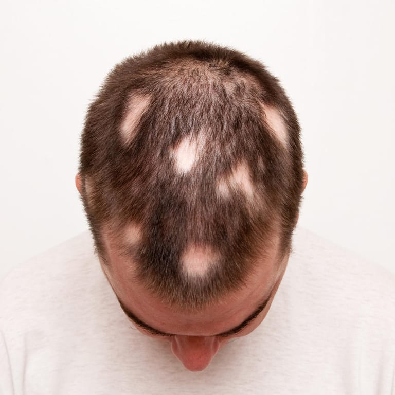 Kopf eines Mannes mit Alopecia areata