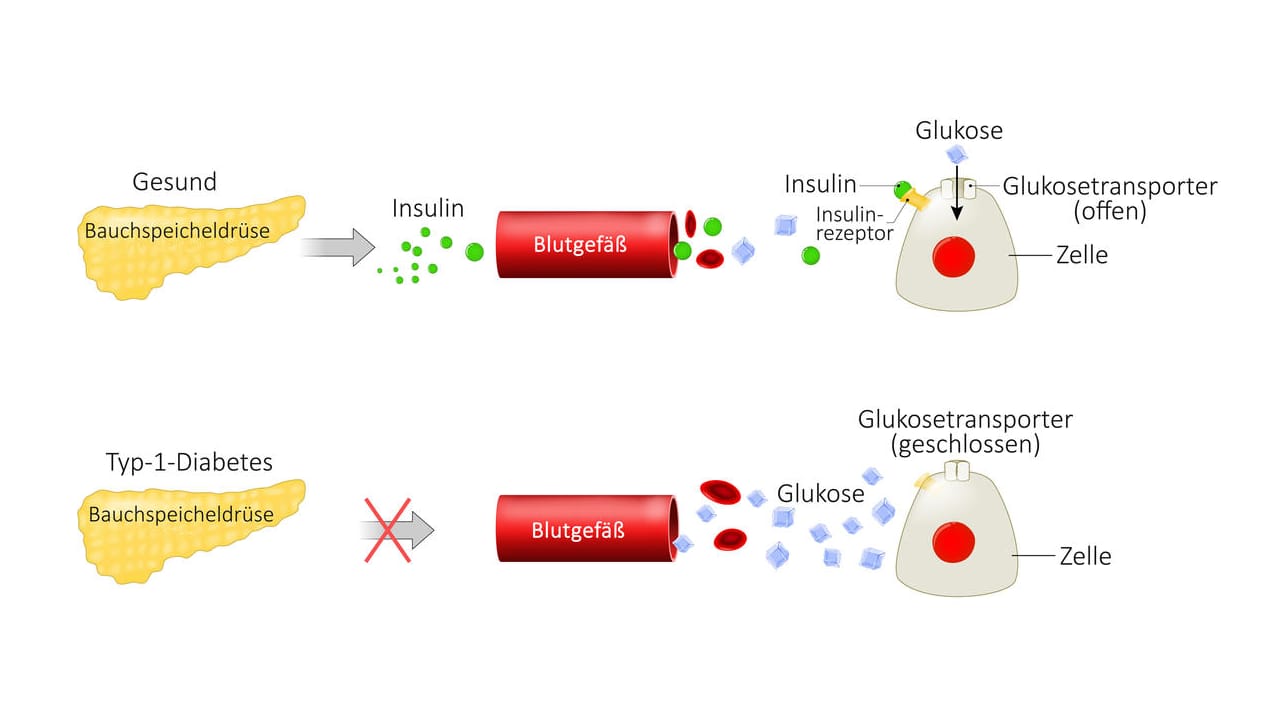 Grafische Darstellung der Ursachen von Typ-1-Diabetes.