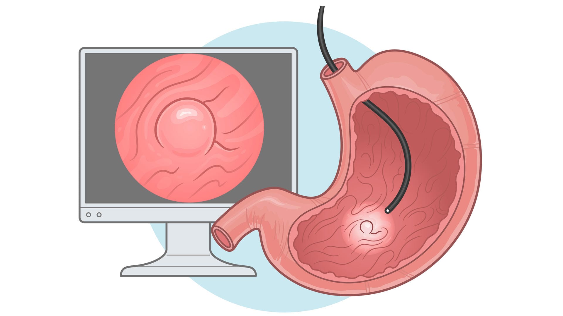 Illustration einer Magenspiegelung