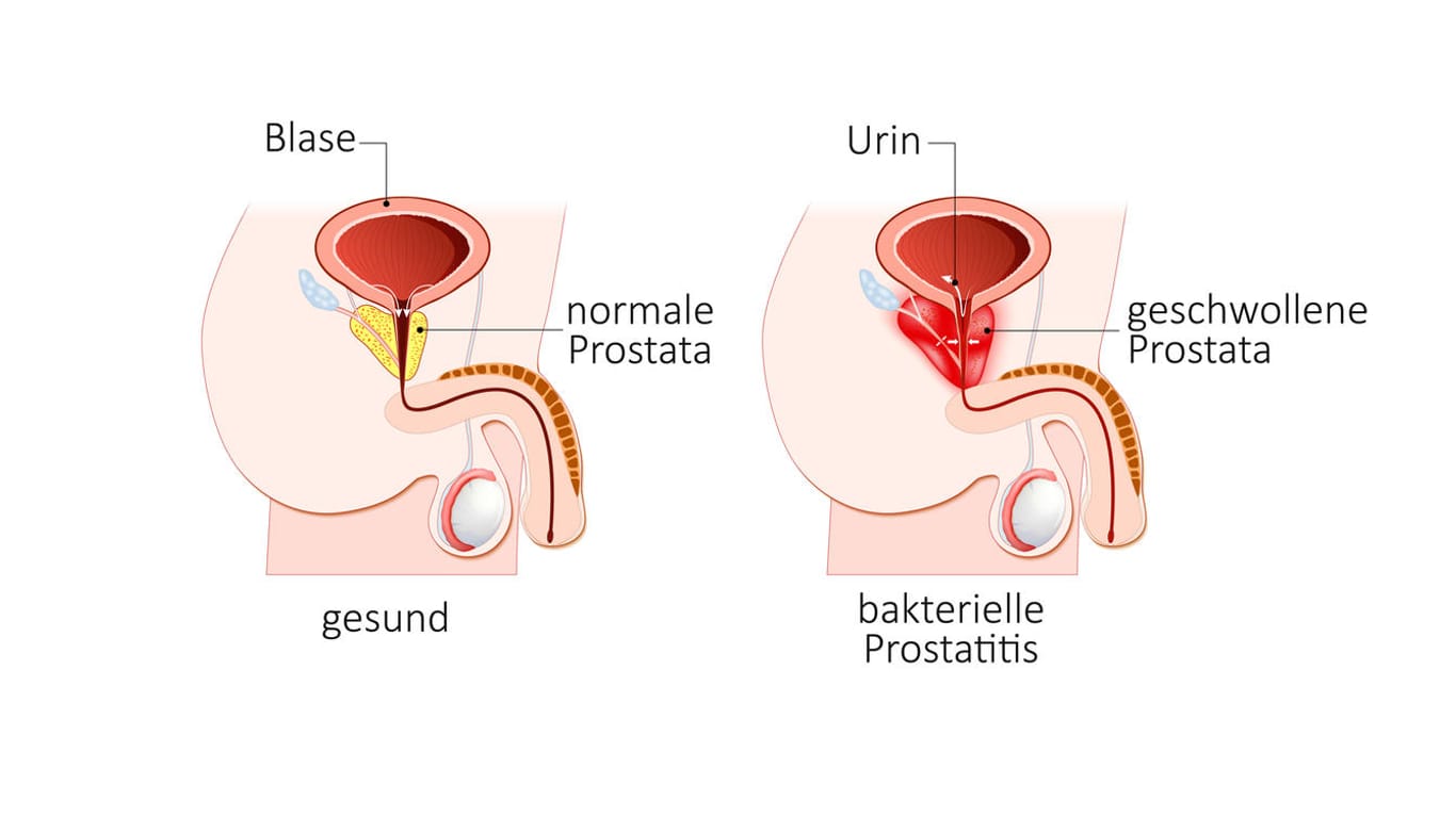 Grafische Darstellung gesunde Prostata und bakterielle Prostatitis.