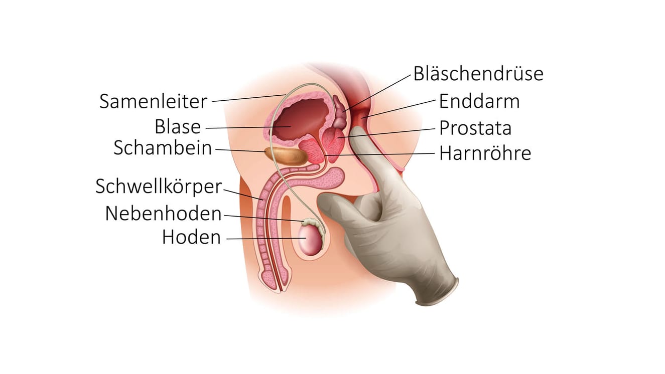 Grafische Darstellung einer Prostatauntersuchung.