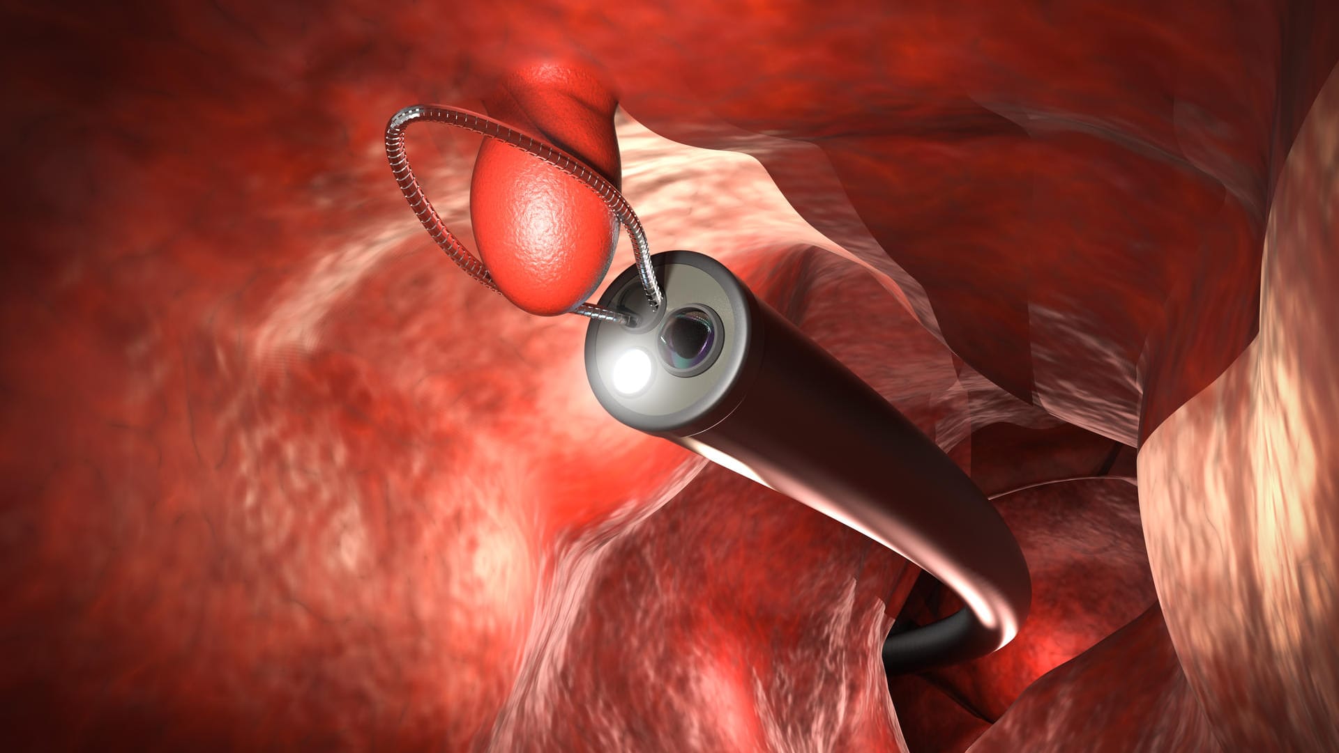 Endoskopische Entfernung eines Darmpolypen