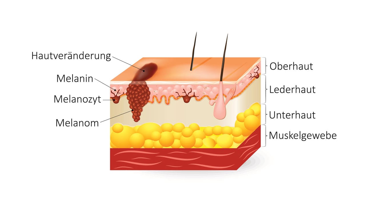 Grafische Darstellung Melanom.