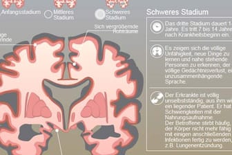 Alzheimer: Die Veränderungen sind im Gehirn erkennbar.