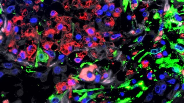 Immunfluoreszenz-Aufnahme der Lunge eines Patienten mit schwerem COVID-19.