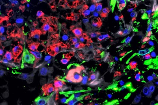 Immunfluoreszenz-Aufnahme der Lunge eines Patienten mit schwerem COVID-19.