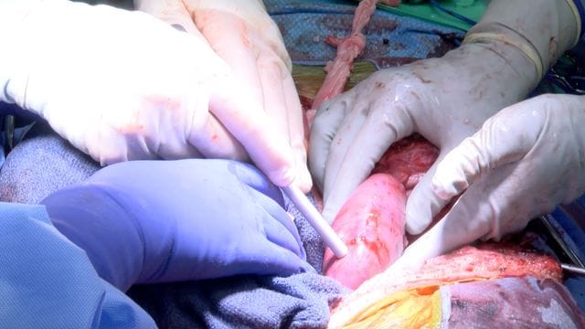 Gut zwei Wochen nach der Transplantation eines Schweineherzens berichten US-Mediziner von der Übertragung von Schweinenieren auf einen Menschen.