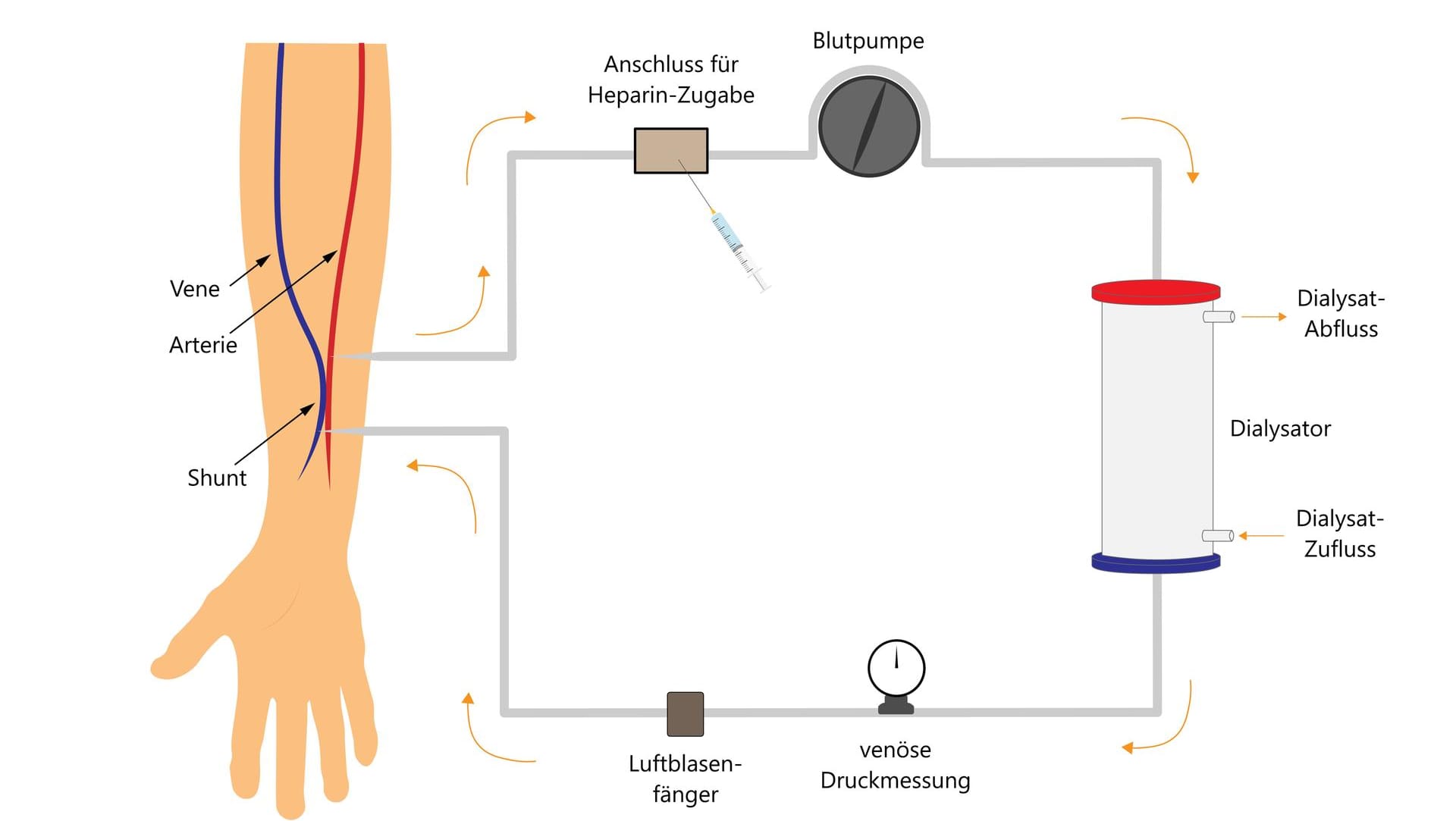 Schematische Darstellung der Hämodialyse