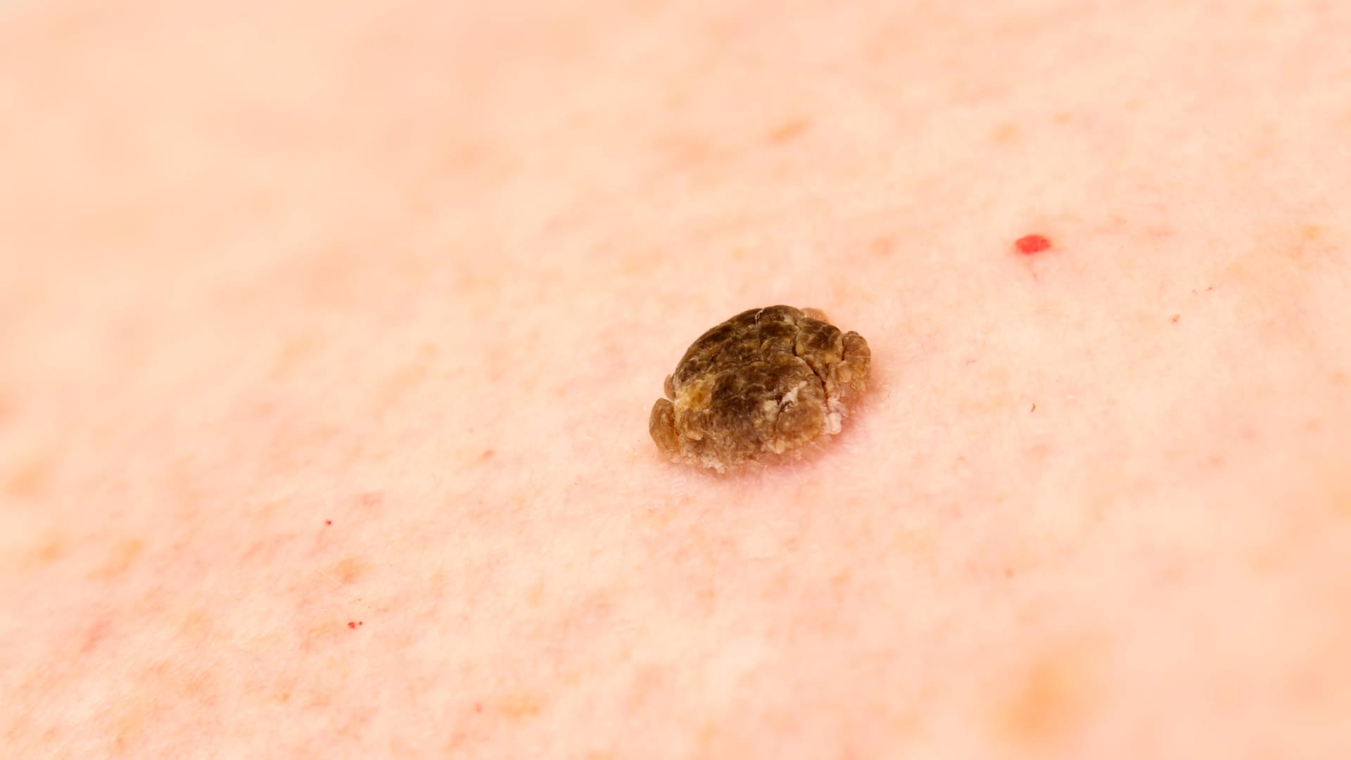 Seborrheic keratosis, narrow focus