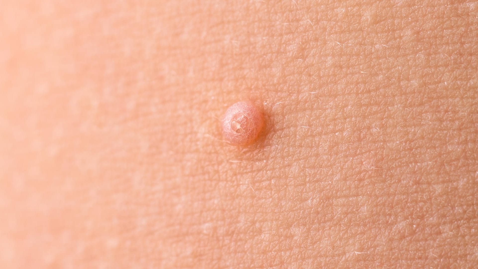 Molluscum contagiosum