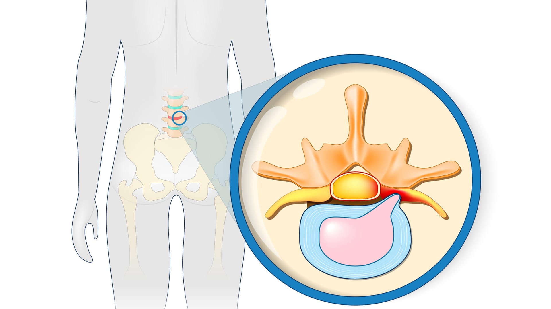 Grafische Darstellung eines Bandscheibenvorfalls.