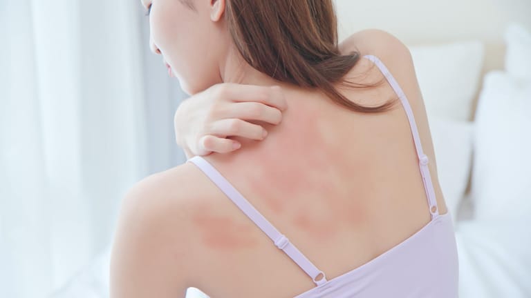 Frau mit Hautausschlag kratzt ihren Rücken: Juckreiz und ein roter Ausschlag auf der Haut können ein Zeichnen für eine allergische Hautreaktion sein.