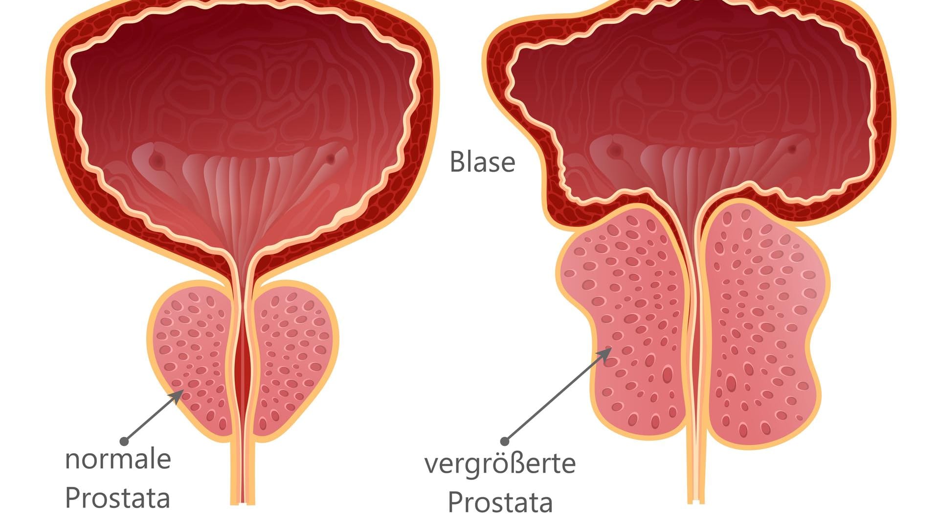 Prostatavergrößerung