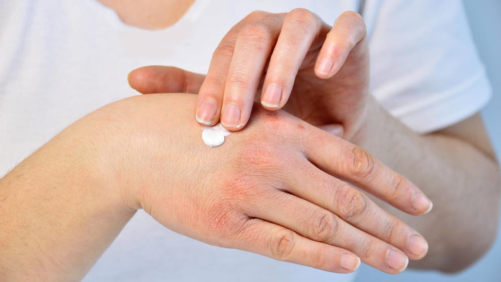 Frau benutzt Salbe an ihrer Hand: Salben mit viel Feuchtigkeit und hohen Fettgehalt eignen sich besonders gut bei trockener Haut.