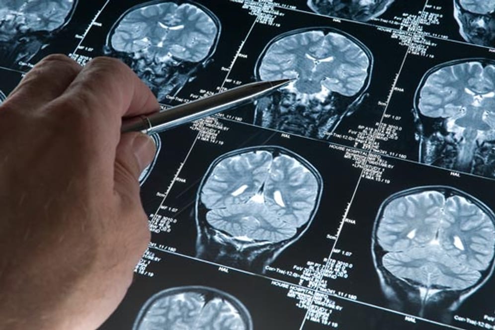 Bei Alzheimer-Patientenfinden schon in jungen Jahren Gehirnveränderungen statt.