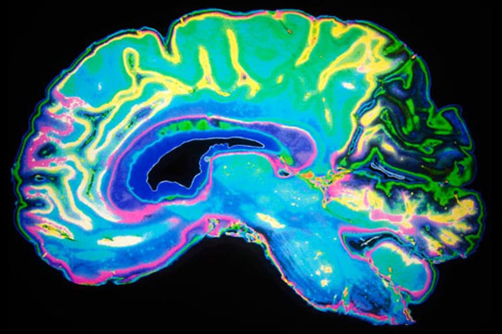 Forscher: Bei Schwerhörigkeit verändert sich auch das Gehirn.