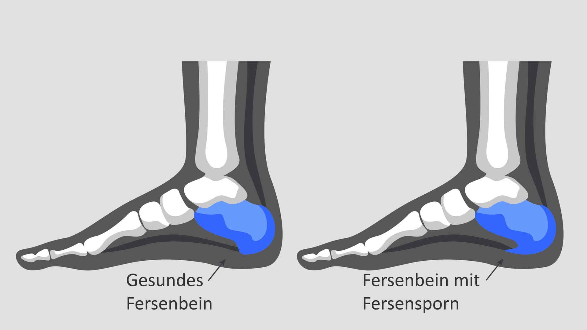 Illustration eines Fersensporns