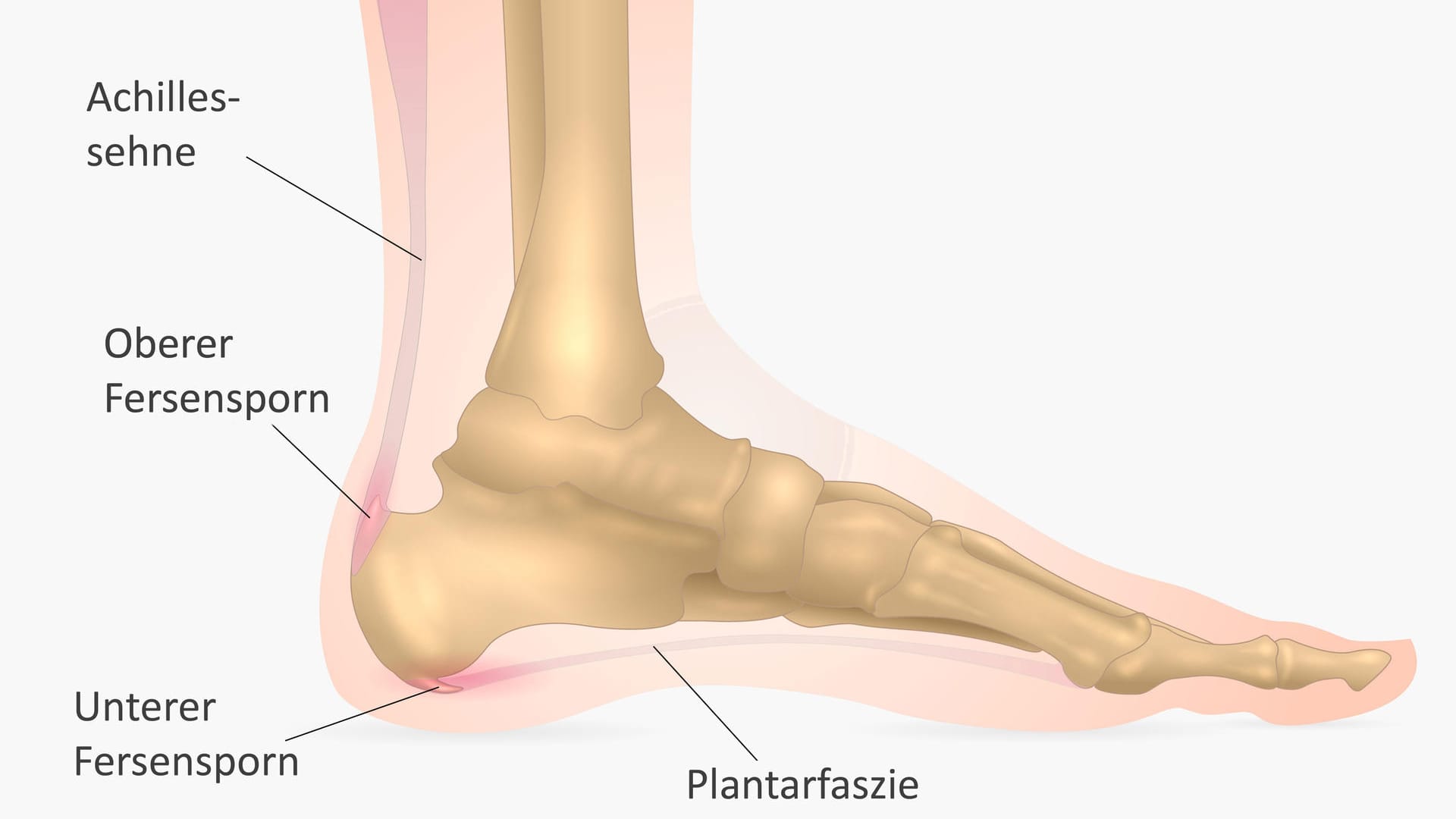 Illustration: oberer und unterer Fersensporn
