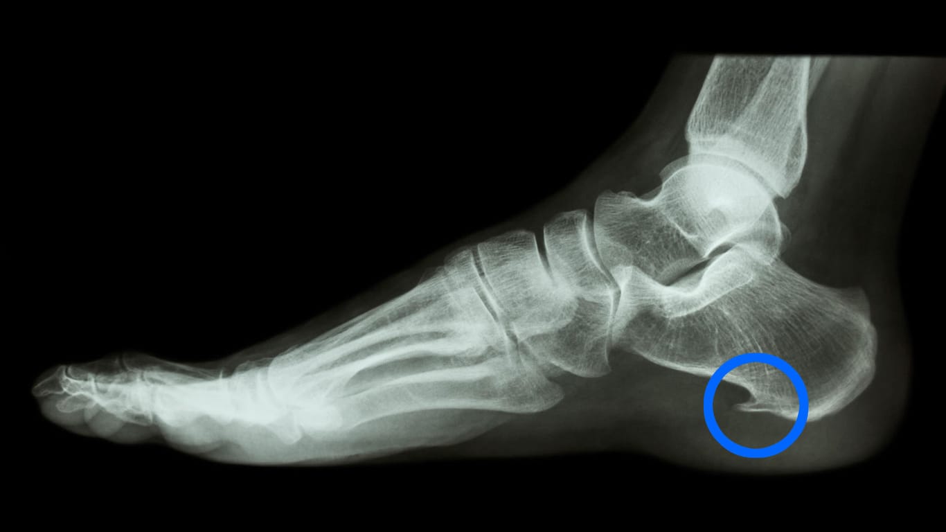 Fersensporn im Röntgenbild.