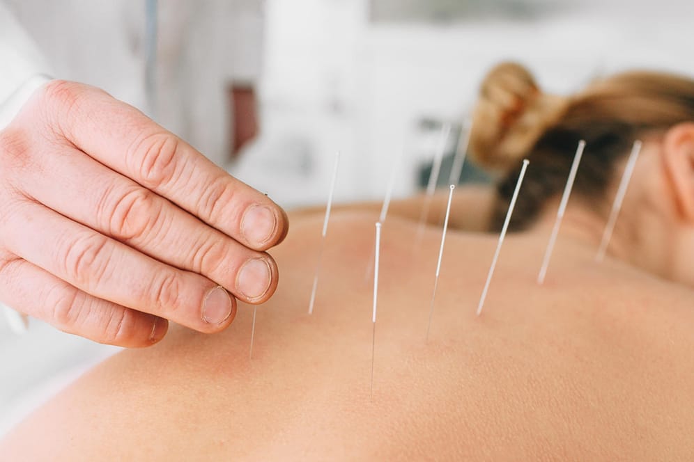 Akupunktur-Behandlung am Rücken