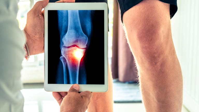 Ein Arzt zeigt eine Röntgenaufnahme von einem Knie. Bei einer fortgeschrittenen Arthrose kann ein künstliches Kniegelenk notwendig werden.