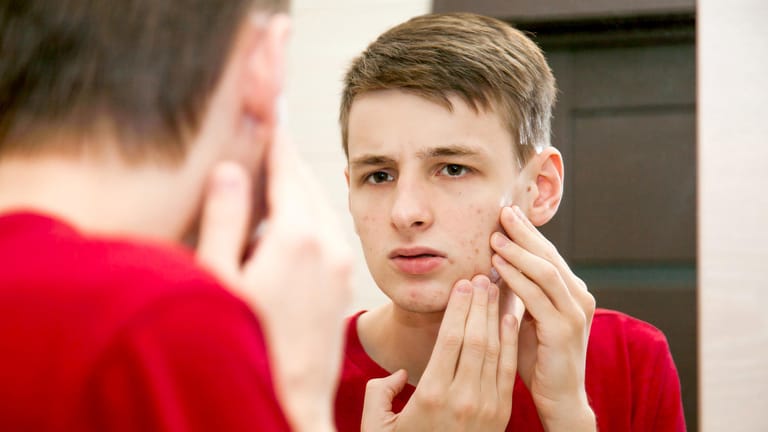 Heranwachsender mit Akne im Gesicht
