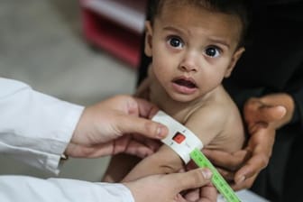 Ein syrisches Kind wird aufgrund von Unterernährung medizinisch behandelt.