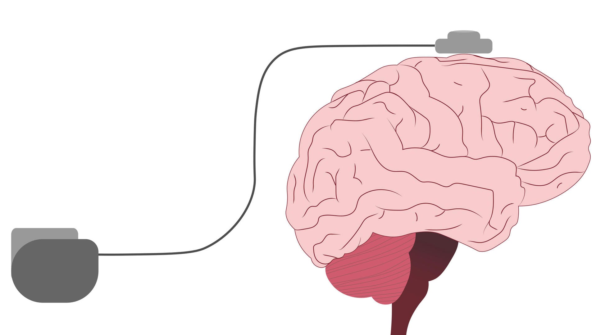 Illustration: Impulsgeber mit Elektroden am Hirn