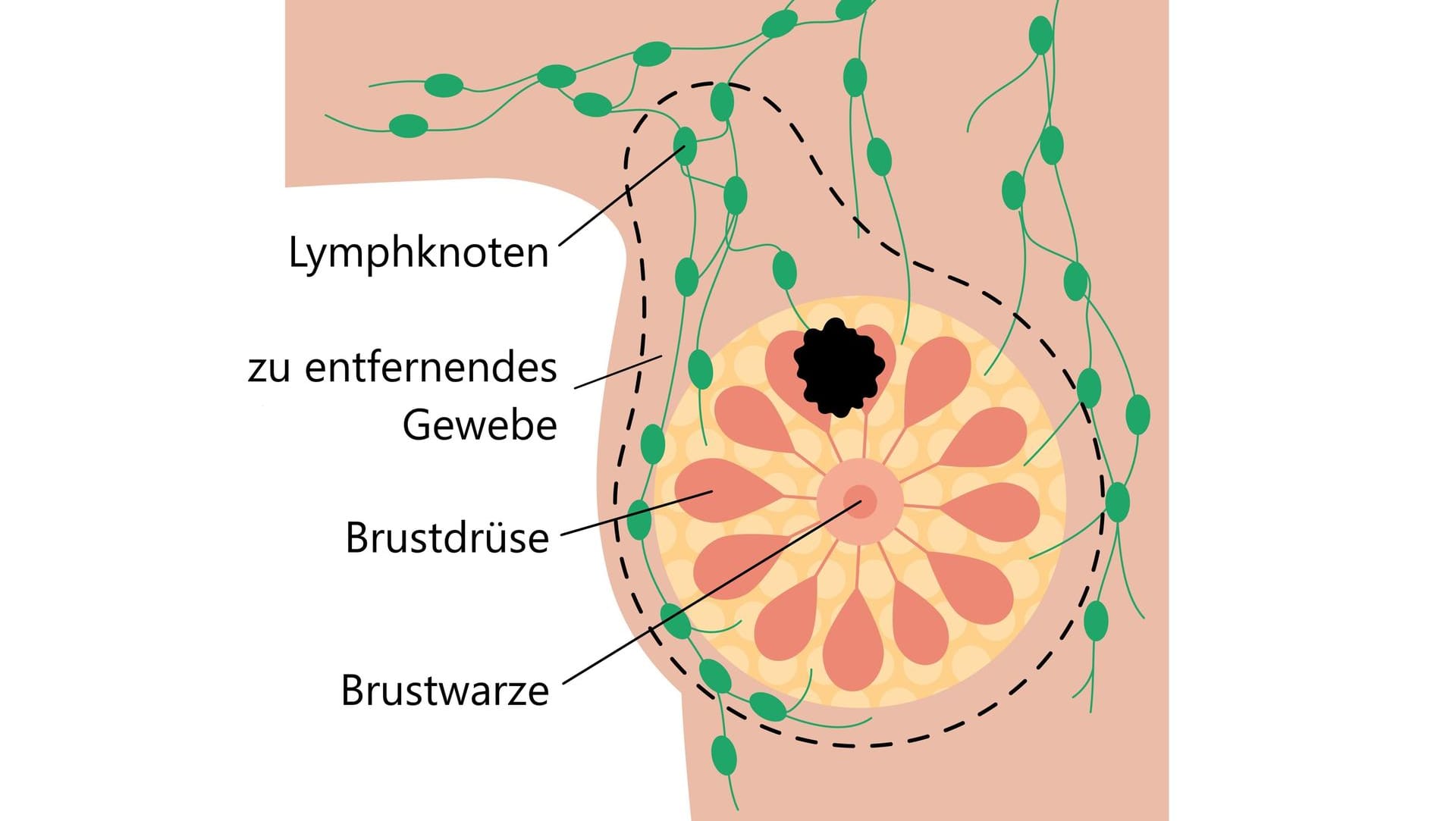 Schematische Darstellung der radikalen Mastektomie