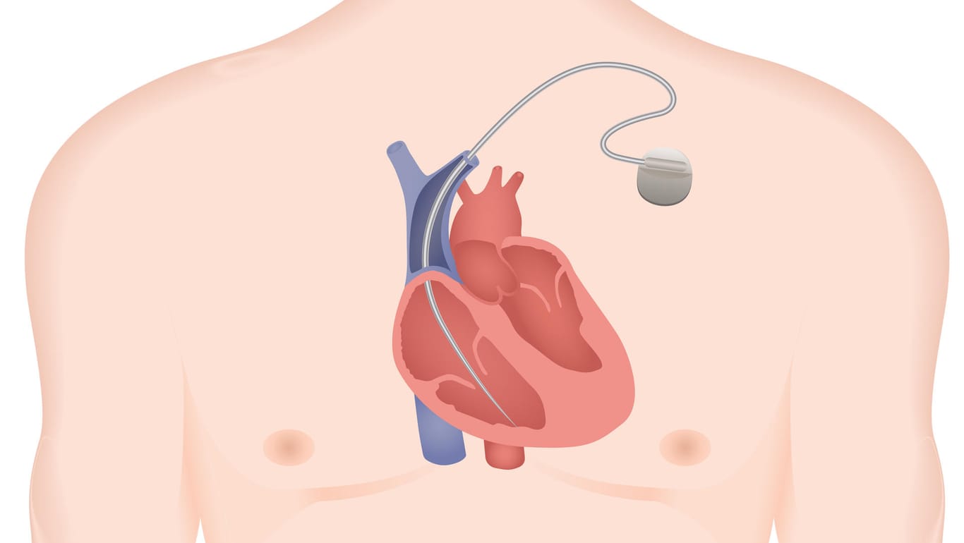 Schematische Darstellung eines implantierbaren Kardioverter-Defibrillators