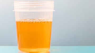 Eiweiß im Urin (Proteinurie): Ursachen, Bedeutung, Therapie