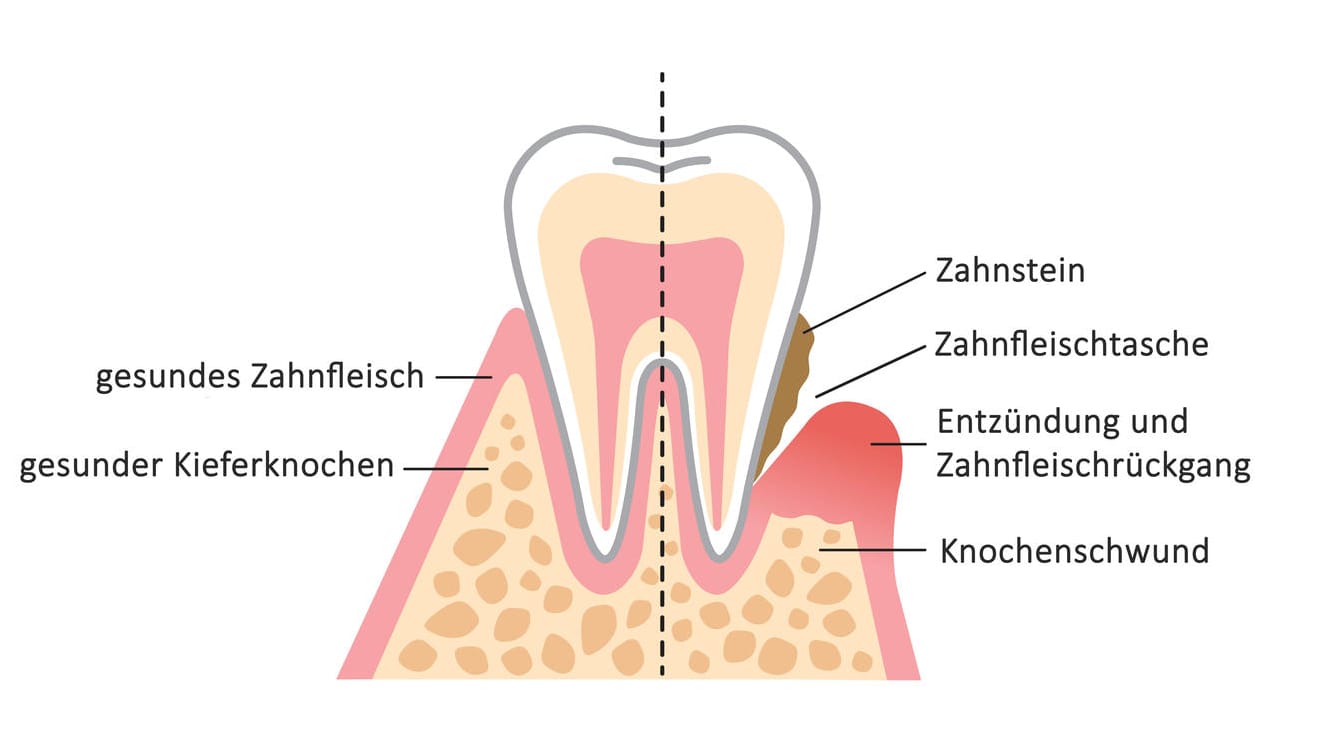 Grafische Darstellung Parodontitis.