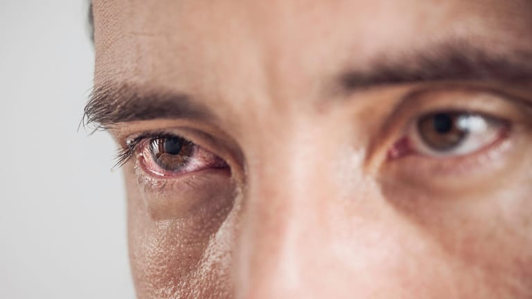 Gereizte Augen: Sie entstehen vor allem, wenn die Augen zu trocken sind. Menschen, die unter einer Allergie leiden oder viel vor dem Computer sitzen haben häufig diese Beschwerden.