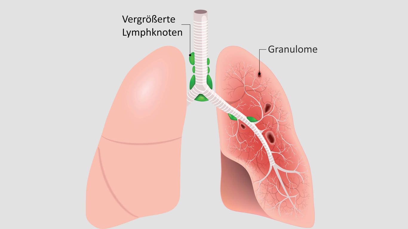 Illustration: Granulome und vergrößerte Lymphknoten in der Lunge bei einer Sarkoidose