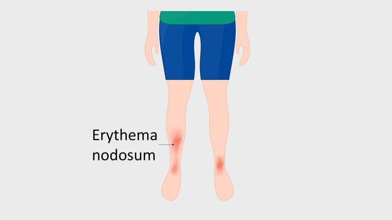 Illustration eines Erythema nodosum