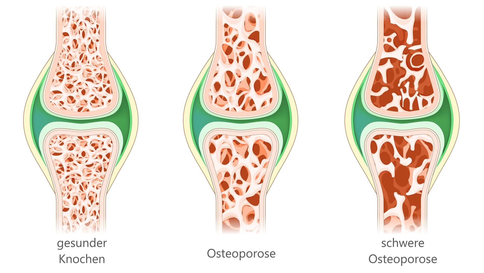 Schematische Darstellung von Osteoporose