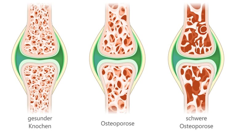 Schematische Darstellung von Osteoporose