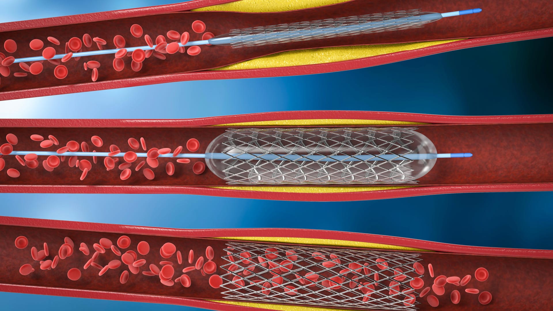 Illustration Ballon-Angioplastie.