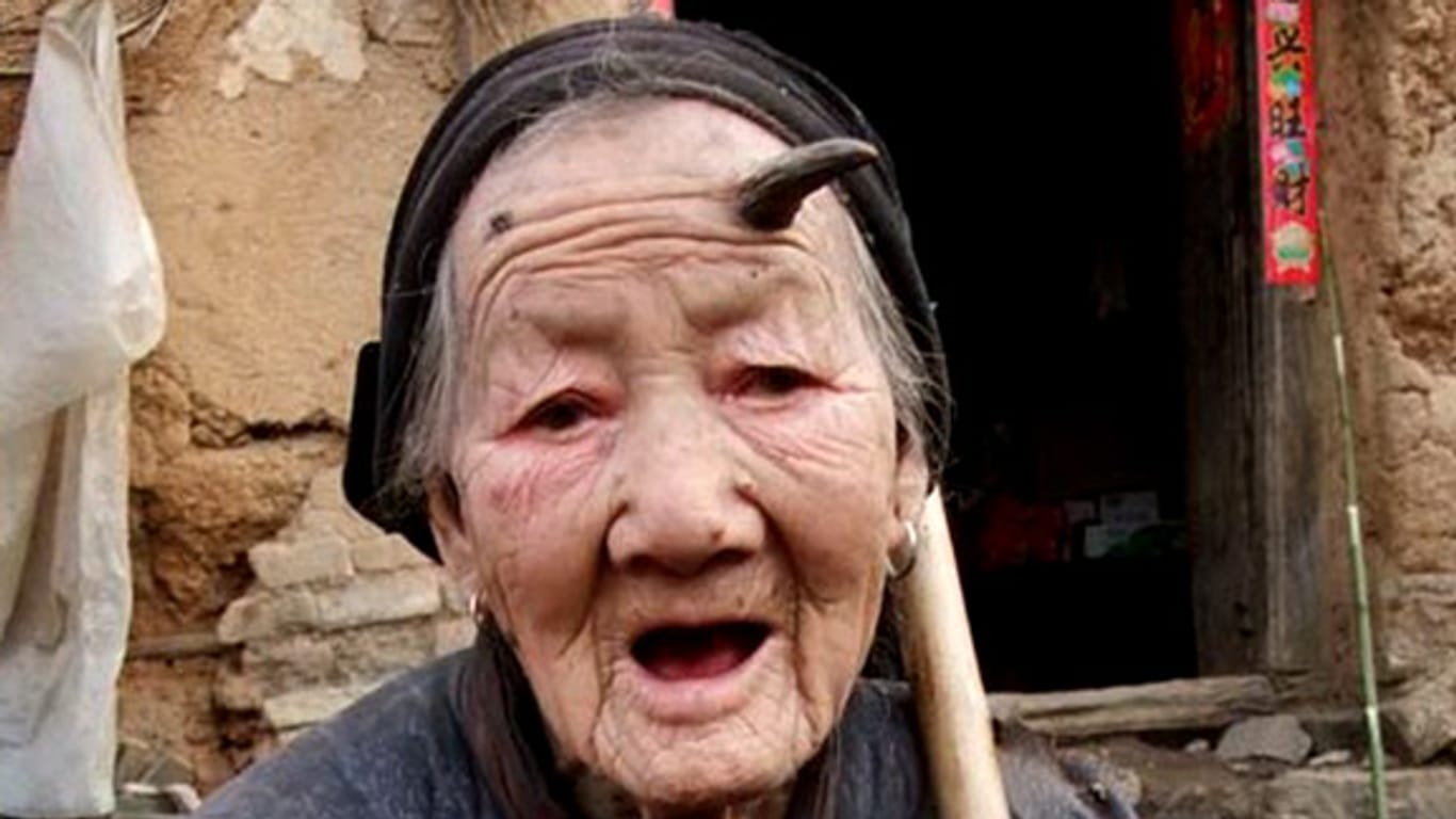 Krankheiten: Zhang Ruifang wächst ein Horn auf der Stirn.