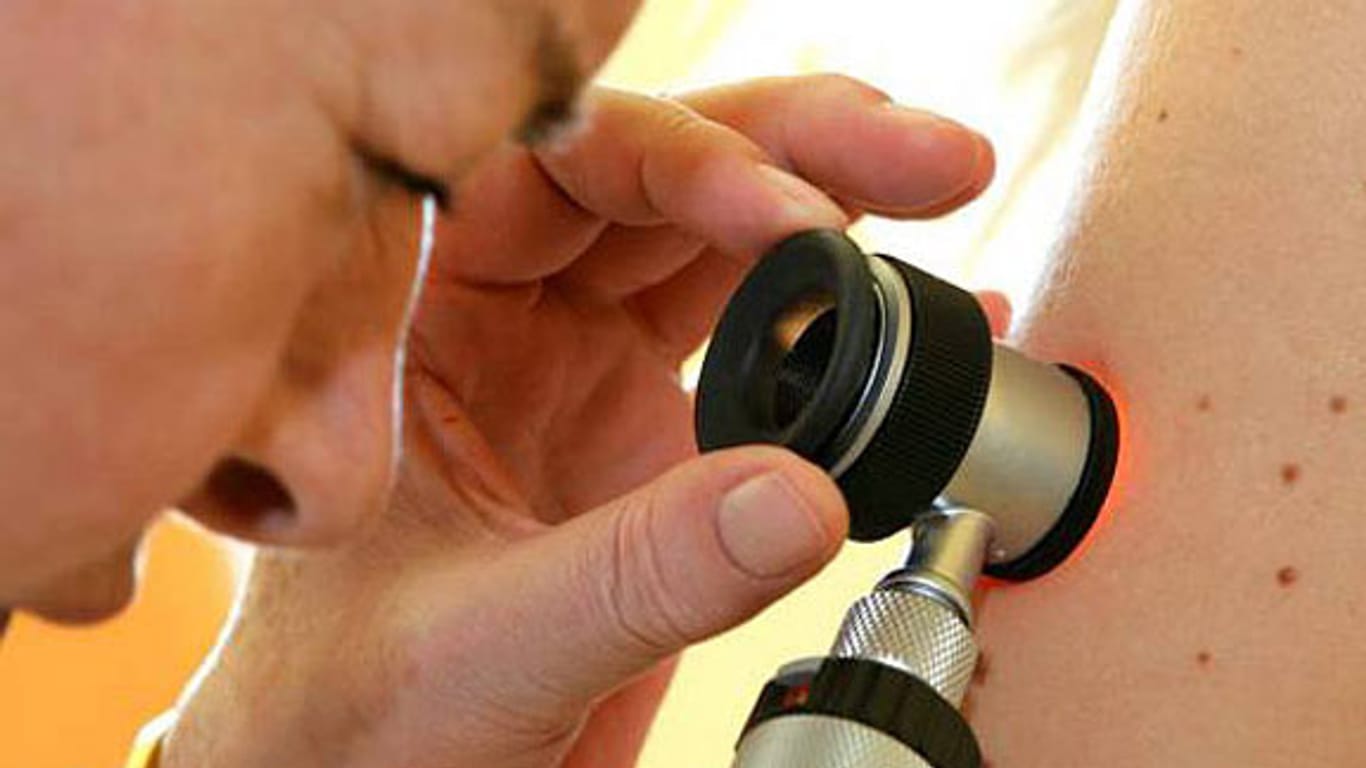 Hautkrebs-Vorsorgeuntersuchung mit dem Auflichtmikroskop.