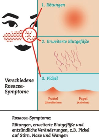 Zum Großklicken: Typische Rosacea-Symptome.
