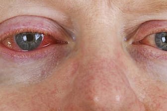 Rote Augen können viele Ursachen haben - zum Beispiel eine Allergie.