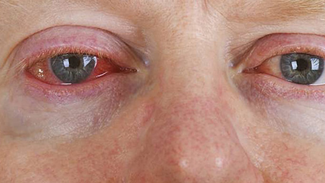 Rote Augen können viele Ursachen haben - zum Beispiel eine Allergie.
