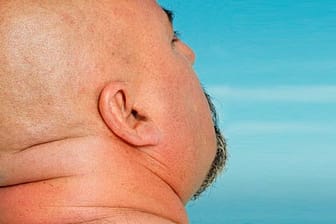 Hautkrebs: Männer mit Glatze besonders gefährdet.