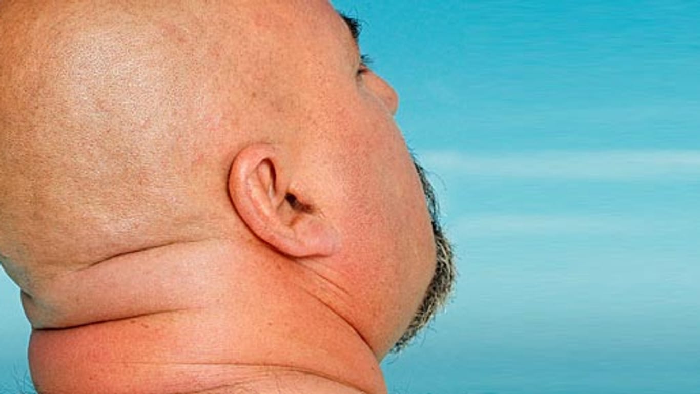 Hautkrebs: Männer mit Glatze besonders gefährdet.