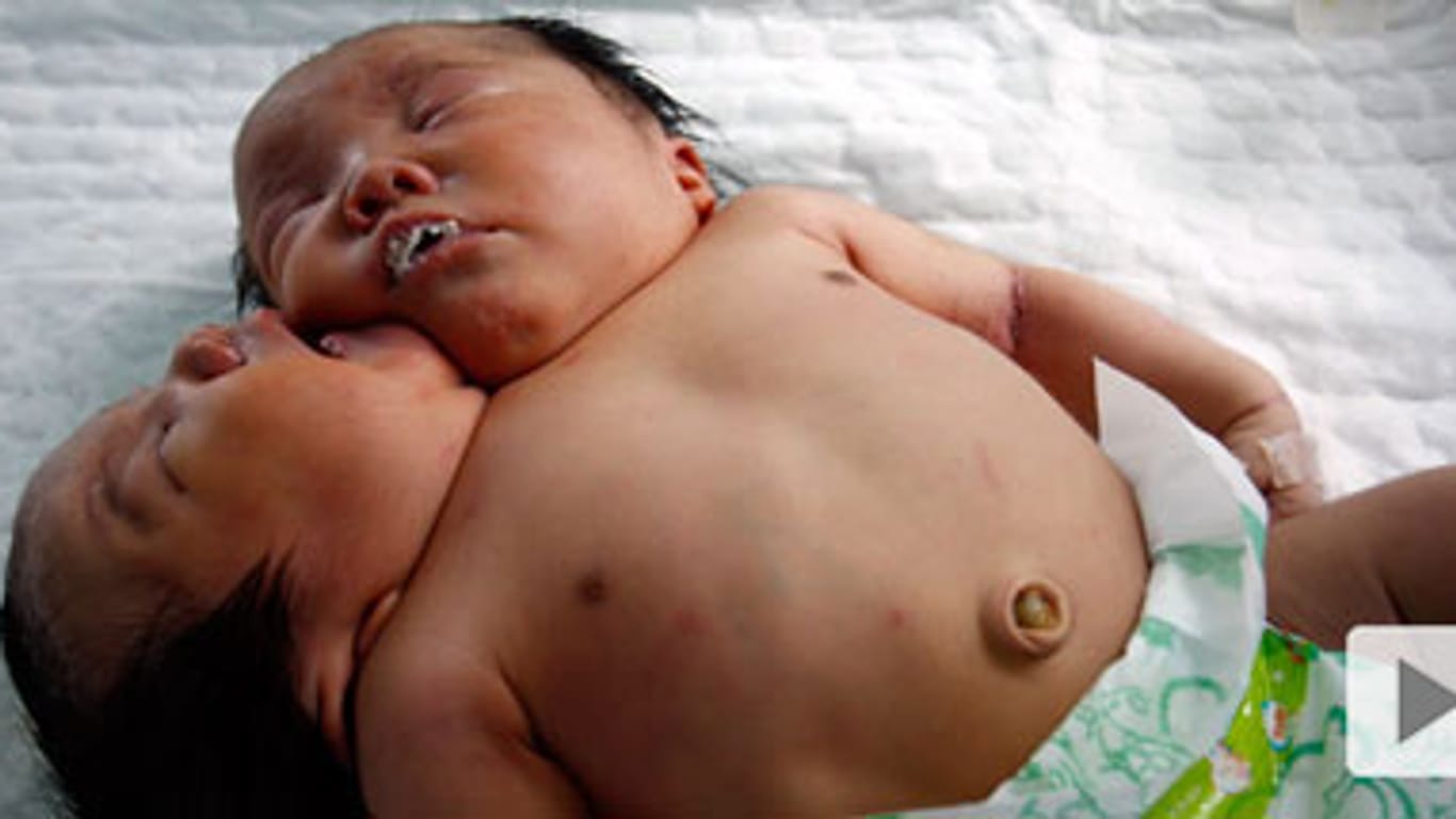 In China geborene Siamesische Zwillinge teilen sich einen Körper und die meisten Organe