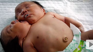 In China geborene Siamesische Zwillinge teilen sich einen Körper und die meisten Organe In China geborene Siamesische Zwillinge teilen sich einen Körper und die meisten Organe
